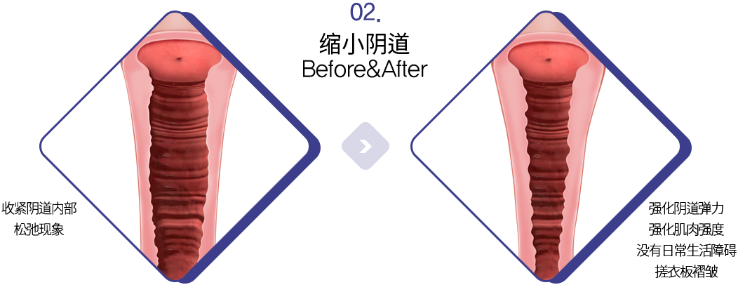 缩小阴道 Before&After 收紧阴道内部松弛现象 强化阴道弹力强化肌肉强度没有日常生活障碍搓衣板褶皱