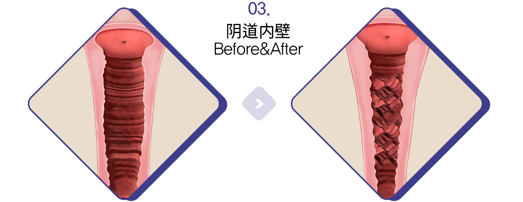 阴道内壁 Before&After