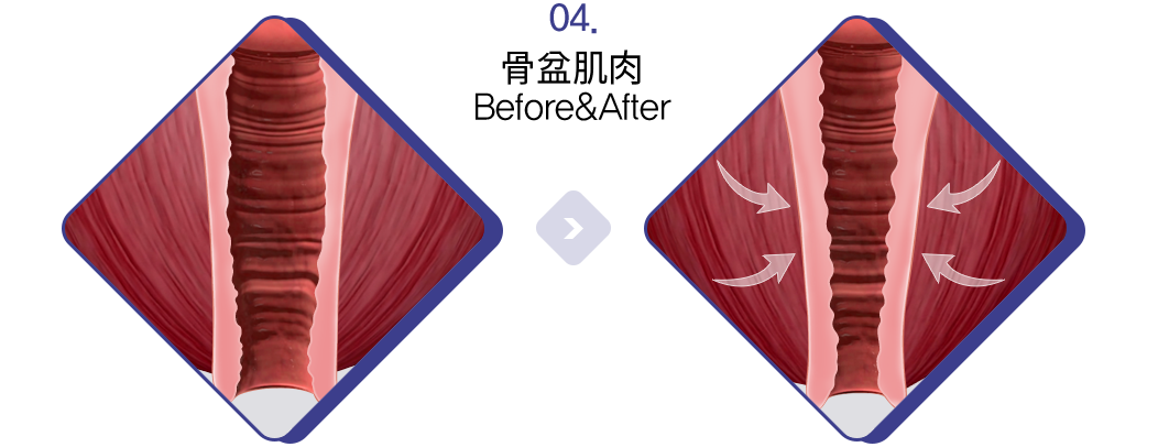 骨盆肌肉 Before&After