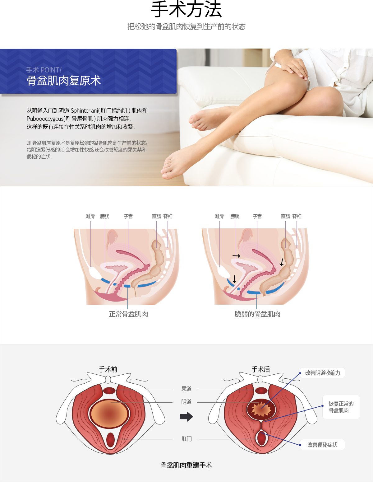 手术方法 把松弛的骨盆肌肉恢复到生产前的状态